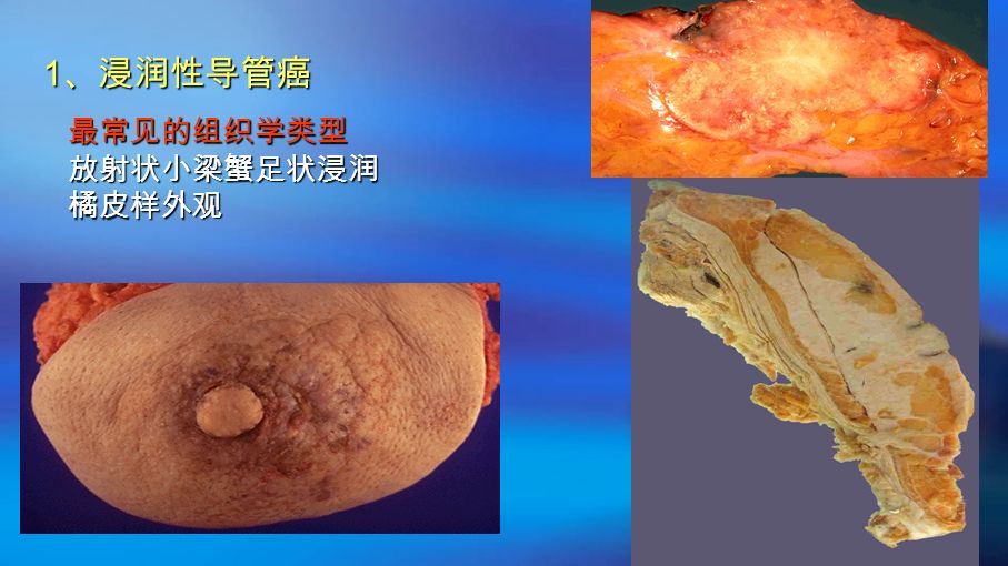 1 、浸润性导管癌 最常见的组织学类型放射状小梁蟹足状浸润橘皮样外观