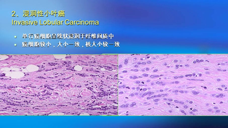 2 、浸润性小叶癌 Invasive Lobular Carcinoma  单行癌细胞呈线状浸润于纤维间质中  癌细胞较小，大小一致，核大小较一致