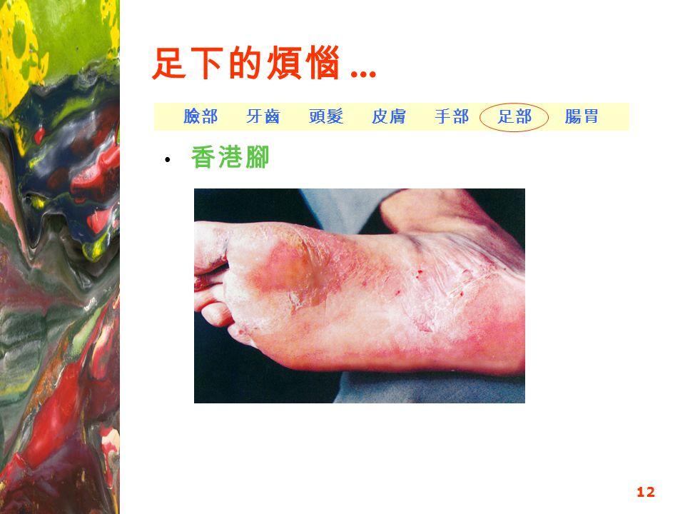 12 足下的煩惱... 香港腳 臉部 牙齒 頭髮 皮膚 手部 足部 腸胃