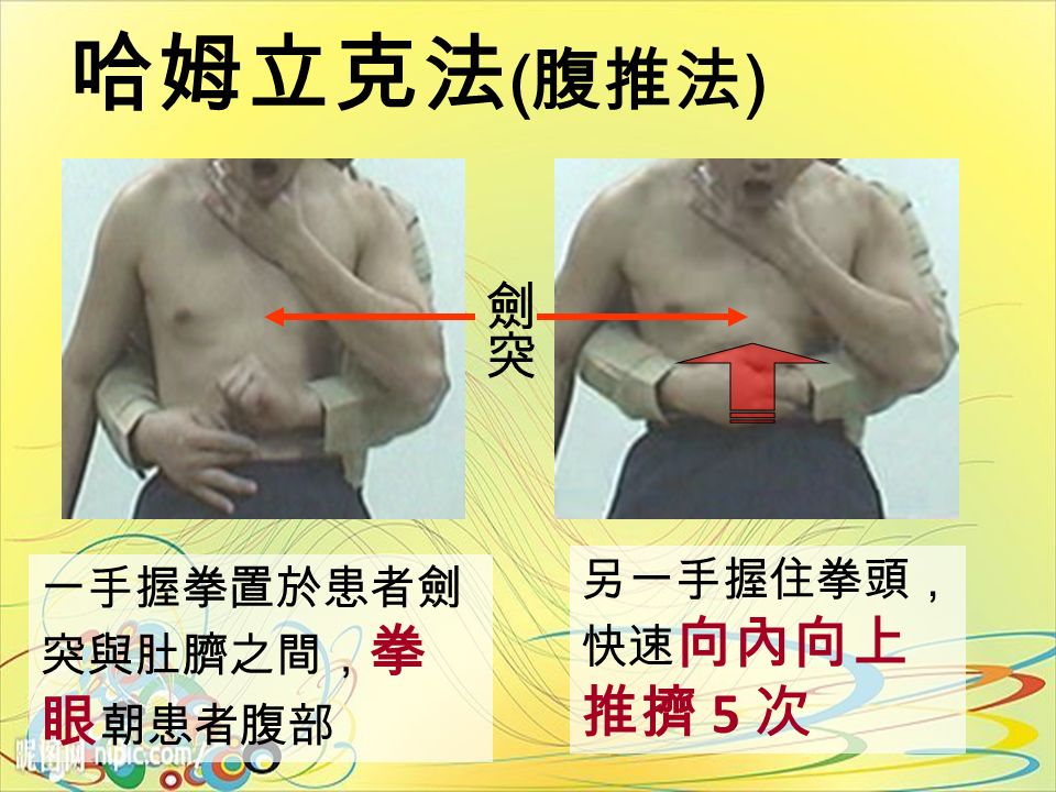 哈姆立克法 ( 腹推法 ) 一手握拳置於患者劍 突與肚臍之間， 拳 眼 朝患者腹部 另一手握住拳頭， 快速 向內向上 推擠 5 次