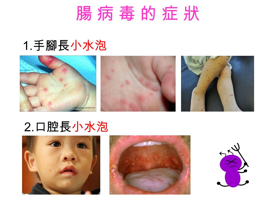 腸 病 毒 的 症 狀腸 病 毒 的 症 狀 1. 手腳長小水泡 2. 口腔長小水泡