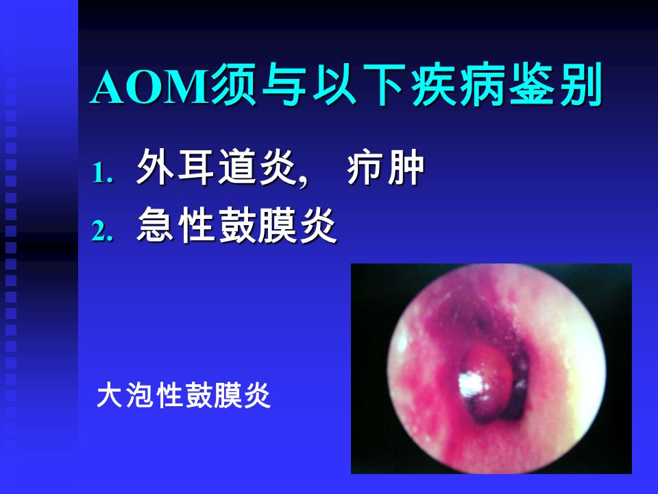 AOM 须与以下疾病鉴别 1. 外耳道炎, 疖肿 2. 急性鼓膜炎 大泡性鼓膜炎