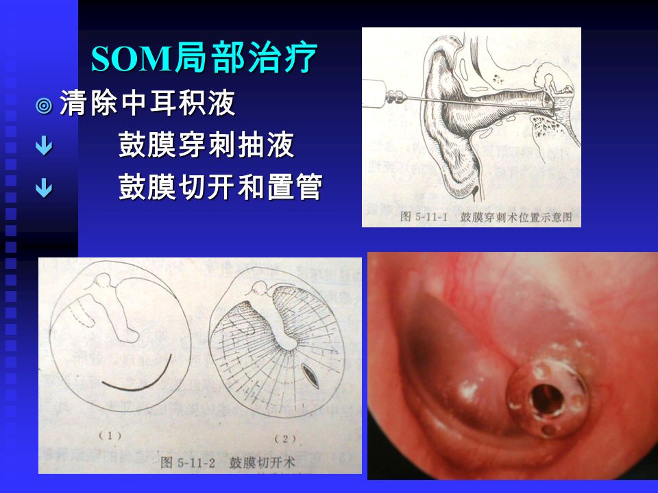 SOM 局部治疗 ¥ 清除中耳积液 ê 鼓膜穿刺抽液 ê 鼓膜切开和置管