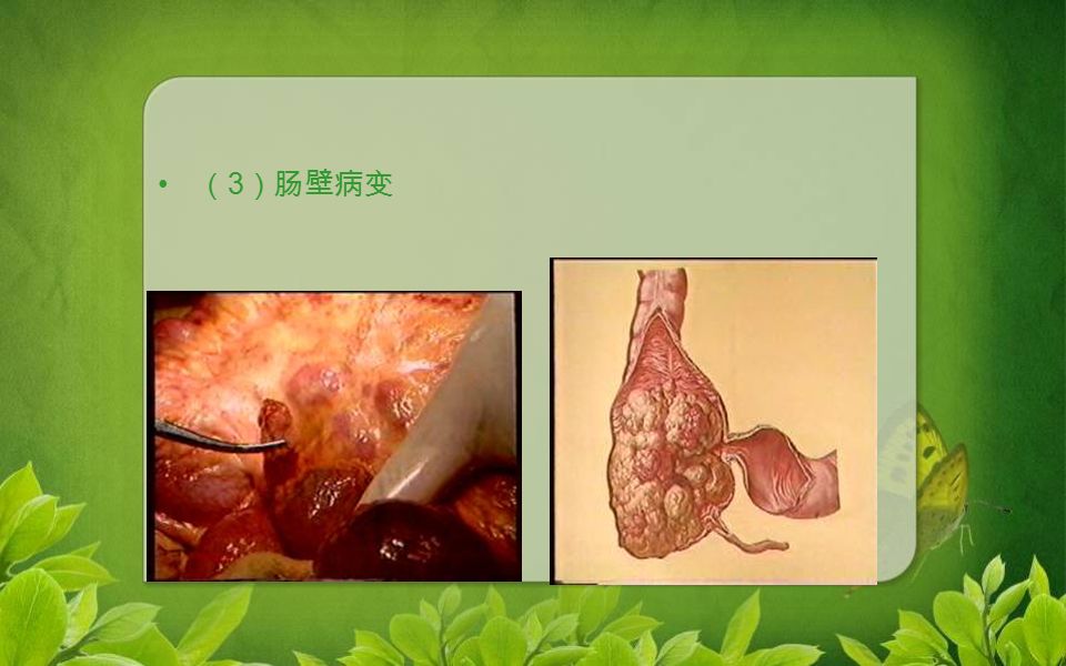 （ 3 ）肠壁病变