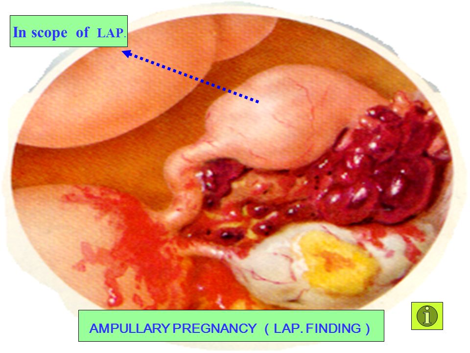 AMPULLARY PREGNANCY