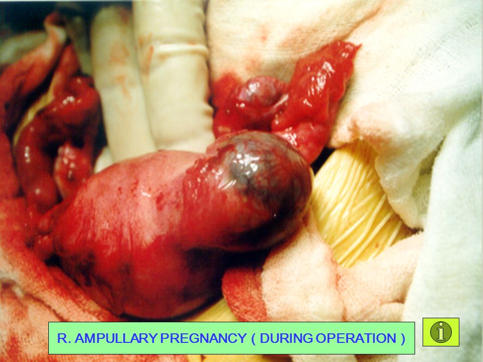 In scope of LAP. AMPULLARY PREGNANCY （ LAP. FINDING ）