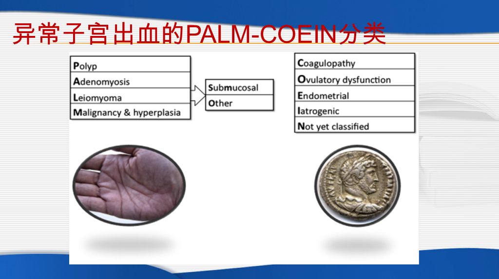 异常子宫出血的 PALM-COEIN 分类