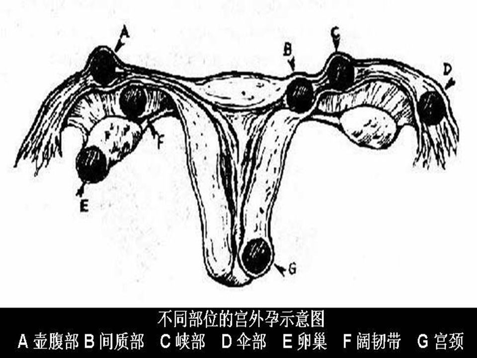 【什么是异位妊娠】 正常情况下，受精卵会由输卵管迁移到子宫 腔，然后安家落户，慢慢发育成胎儿。但是， 由于种种原因，受精卵在迁移的过程中出了 岔子，没有到达子宫，而是在别的地方停留 下来，这就成了宫外孕，医学术语叫异位妊 娠。 正常情况下，受精卵会由输卵管迁移到子宫 腔，然后安家落户，慢慢发育成胎儿。但是， 由于种种原因，受精卵在迁移的过程中出了 岔子，没有到达子宫，而是在别的地方停留 下来，这就成了宫外孕，医学术语叫异位妊 娠。 输卵管妊娠占异位妊娠 95% 左右，壶腹部妊 娠多见，其次是峡部、伞部，间质部妊娠少 见 输卵管妊娠占异位妊娠 95% 左右，壶腹部妊 娠多见，其次是峡部、伞部，间质部妊娠少 见