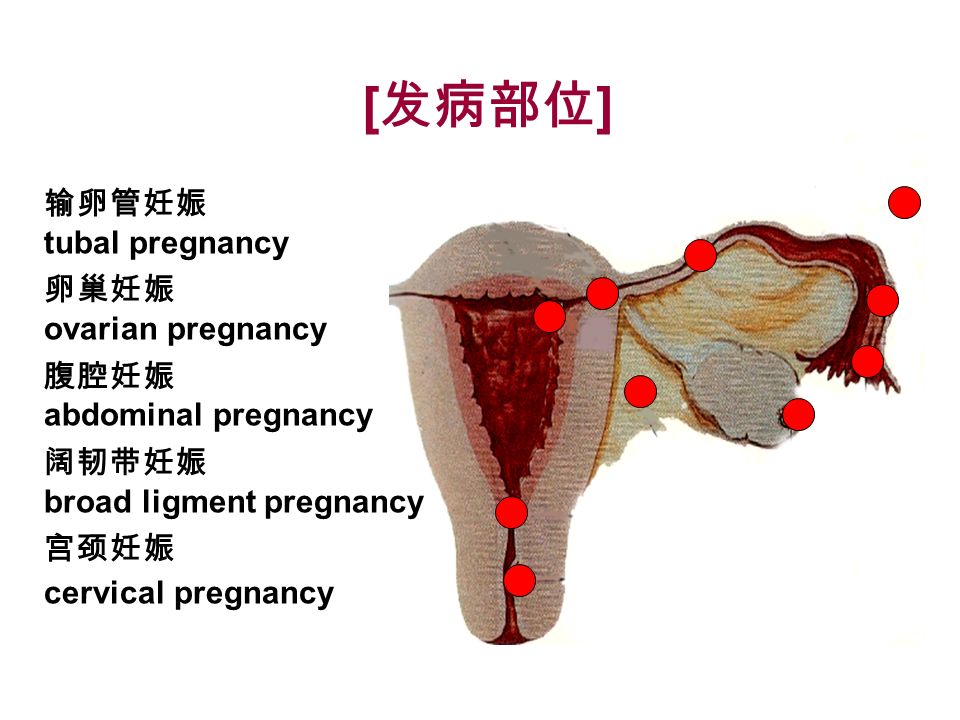 [ 重要性 ] 孕妇孕早（中）期死亡的 主要原因 近年发病率上升