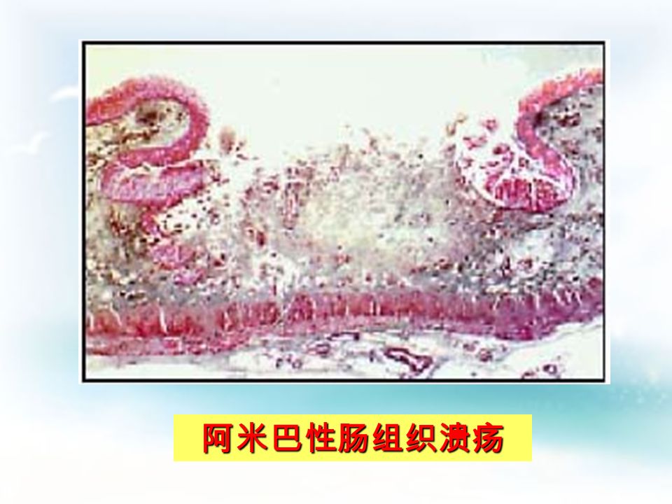 肠壁阿米巴溃疡 示肠粘组织水肿与溃疡膜