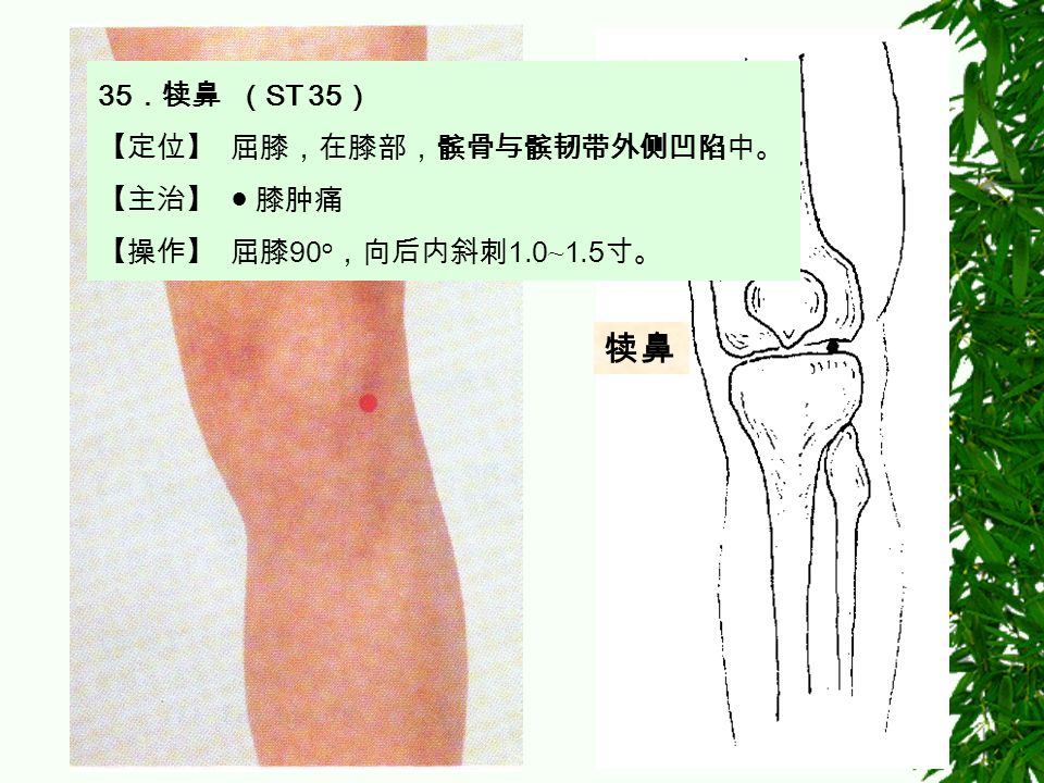 犊鼻 35 ．犊鼻 （ ST 35 ） 【定位】 屈膝，在膝部，髌骨与髌韧带外侧凹陷中。 【主治】 ● 膝肿痛 【操作】 屈膝 90 о ，向后内斜刺 1.0 ~ 1.5 寸。