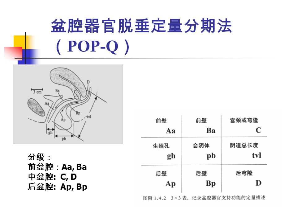 盆腔器官脱垂定量分期法 （ POP-Q ） 分级： 前盆腔： Aa, Ba 中盆腔 : C, D 后盆腔 : Ap, Bp