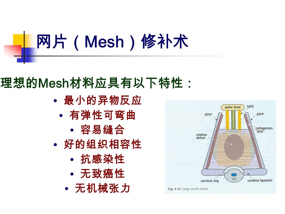 网片（ Mesh ）修补术 理想的 Mesh 材料应具有以下特性： 最小的异物反应 有弹性可弯曲 容易缝合 好的组织相容性 抗感染性 无致癌性 无机械张力