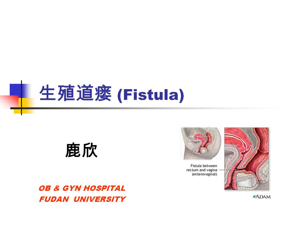 生殖道瘘 (Fistula) 鹿欣 OB & GYN HOSPITAL FUDAN UNIVERSITY