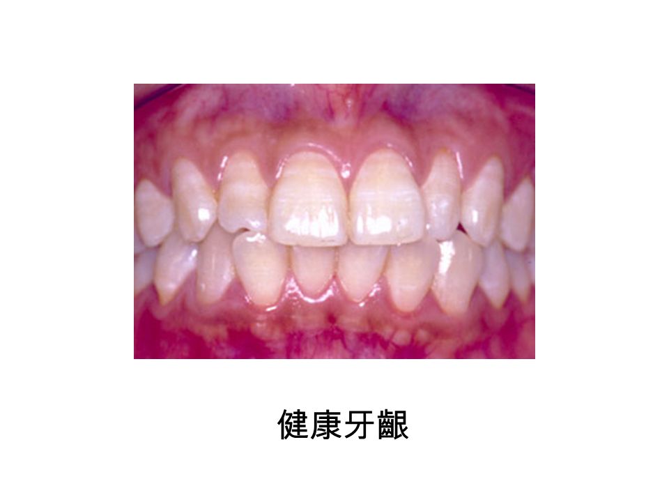 為什麼會有牙週病 積 聚 在 牙 齦 ( 牙 肉 ) 邊 緣 的 牙菌膜分泌 毒 素 令牙週組織發 炎 及 損 傷