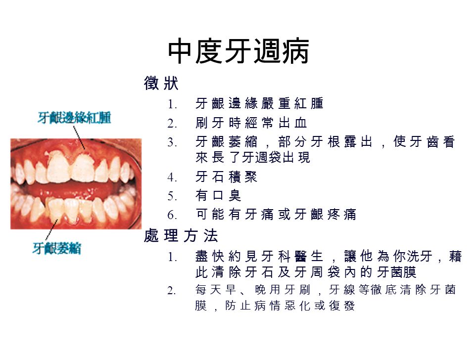 輕微的牙週病 徵 狀 牙 齦 邊 緣 紅 腫 刷 牙 時 牙 齦 容 易 出 血 可 能 有 牙 石 積 聚 可 能 有 牙 痛 或 牙 齦 疼 痛 有 口 臭 處 理 方 法 每 天 早 、 晚 用 牙 刷 、 牙 線 等 ， 徹 底 清 除 牙菌膜。 如 果 有 牙 石 ， 便 需 要洗牙 。 牙 石 清 除 後 ， 要 清 除牙菌膜便 會 更 容 易 、 更 徹 底 。