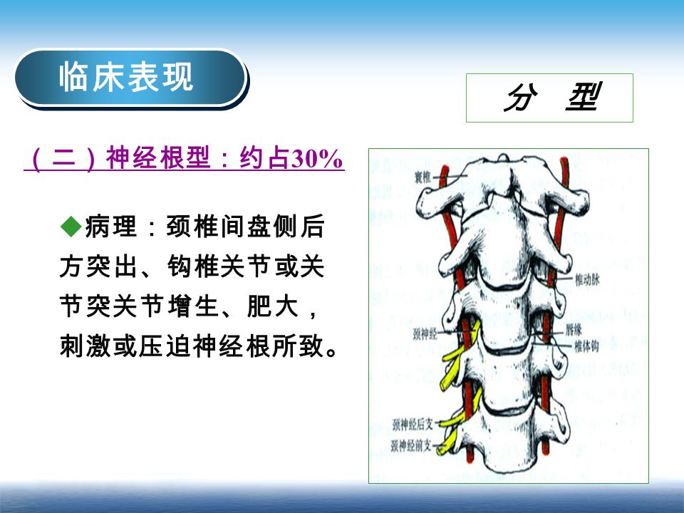 临床表现 分 型  病理：颈椎间盘侧后 方突出、钩椎关节或关 节突关节增生、肥大， 刺激或压迫神经根所致。 （二）神经根型：约占 30%
