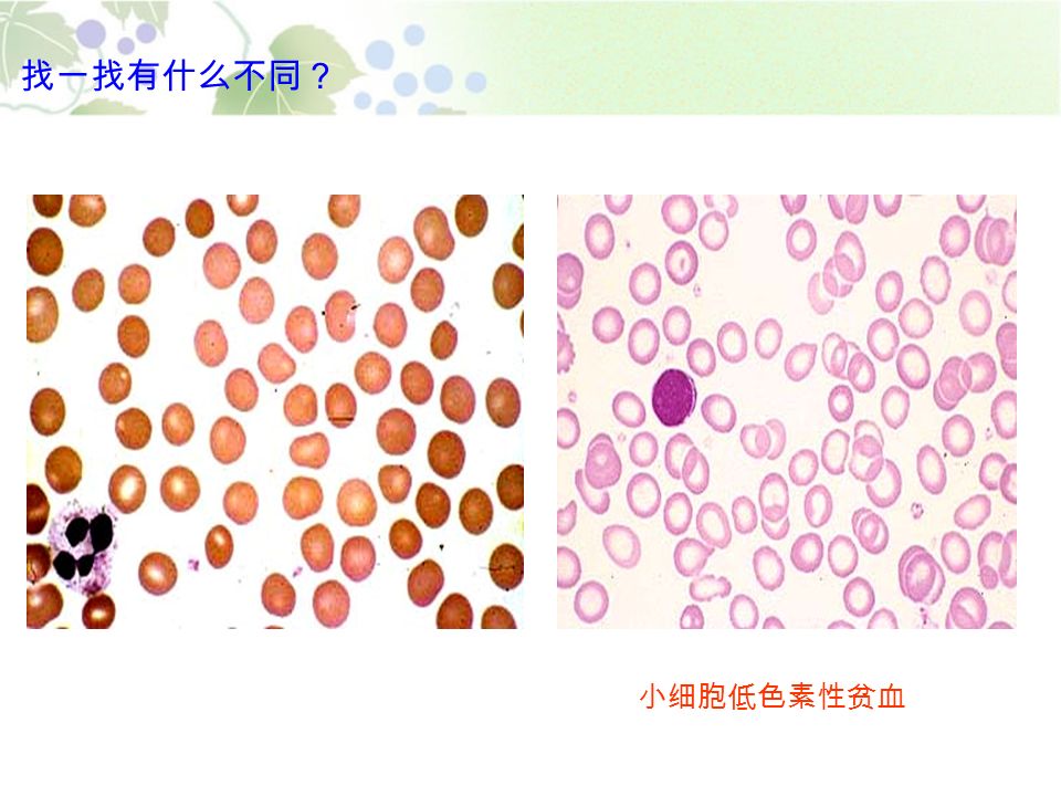 找一找有什么不同？ 小细胞低色素性贫血