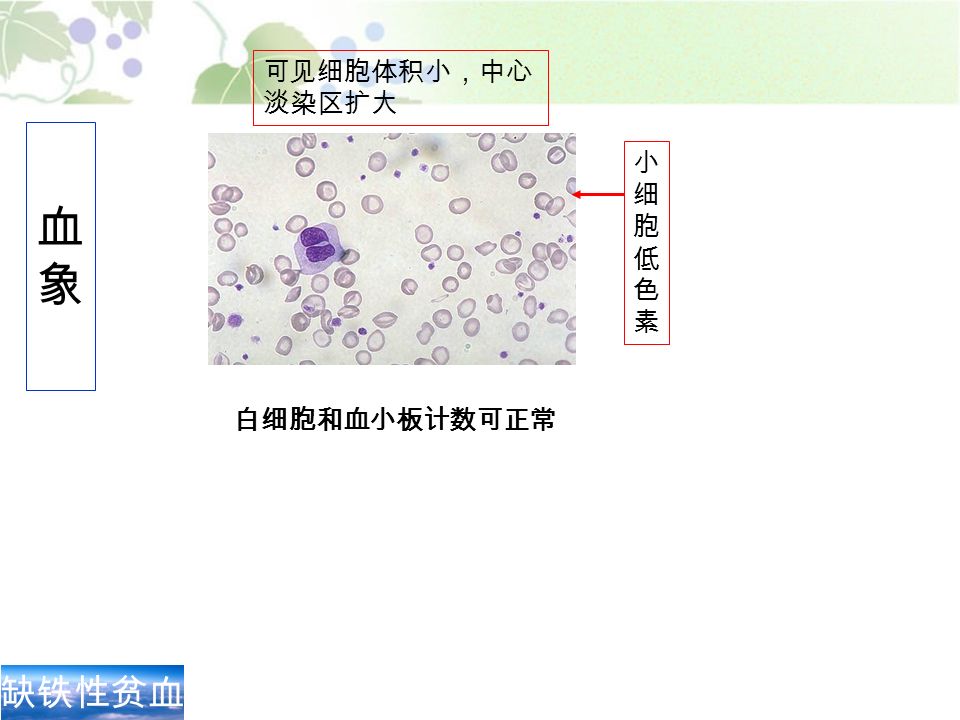 缺铁性贫血 血象血象 小细胞低色素小细胞低色素 白细胞和血小板计数可正常 可见细胞体积小，中心 淡染区扩大
