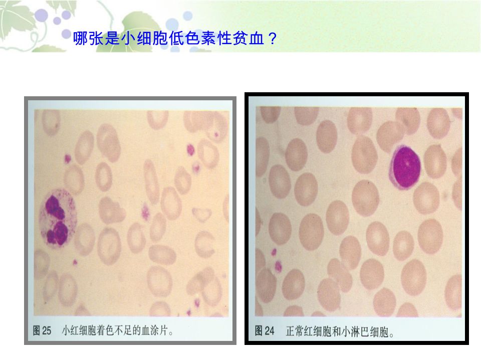 哪张是小细胞低色素性贫血？