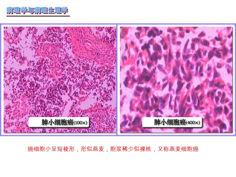 癌细胞小呈短梭形，形似燕麦，胞浆稀少似裸核，又称燕麦细胞癌
