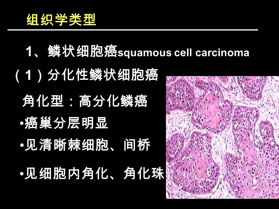 组织学类型 1 、鳞状细胞癌 squamous cell carcinoma （ 1 ）分化性鳞状细胞癌 角化型：高分化鳞癌 癌巢分层明显 见细胞内角化、角化珠 见清晰棘细胞、间桥