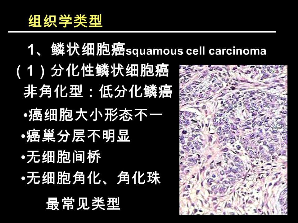 组织学类型 1 、鳞状细胞癌 squamous cell carcinoma （ 1 ）分化性鳞状细胞癌 非角化型：低分化鳞癌 癌巢分层不明显 无细胞角化、角化珠 无细胞间桥 癌细胞大小形态不一 最常见类型