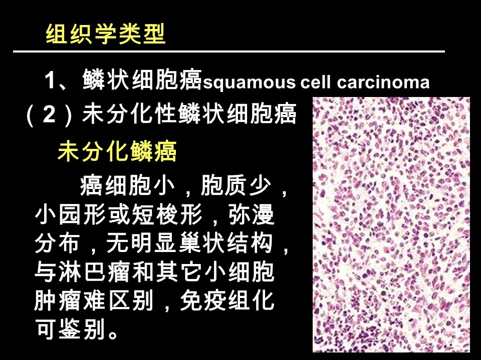 组织学类型 1 、鳞状细胞癌 squamous cell carcinoma （ 2 ）未分化性鳞状细胞癌 未分化鳞癌 癌细胞小，胞质少， 小园形或短梭形，弥漫 分布，无明显巢状结构， 与淋巴瘤和其它小细胞 肿瘤难区别，免疫组化 可鉴别。