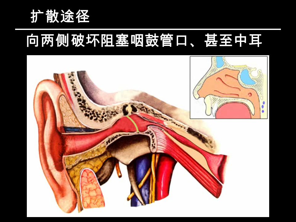扩散途径 向两侧破坏阻塞咽鼓管口、甚至中耳