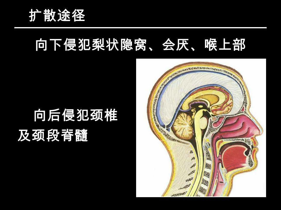 扩散途径 向下侵犯梨状隐窝、会厌、喉上部 向后侵犯颈椎 及颈段脊髓