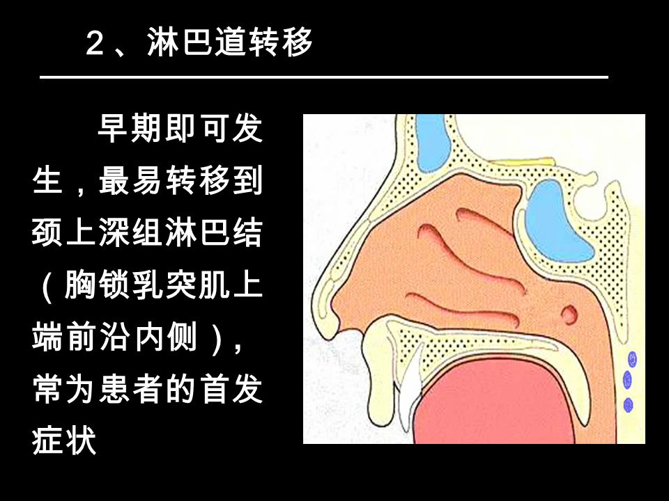 ２、淋巴道转移 早期即可发 生，最易转移到 颈上深组淋巴结 （胸锁乳突肌上 端前沿内侧）, 常为患者的首发 症状
