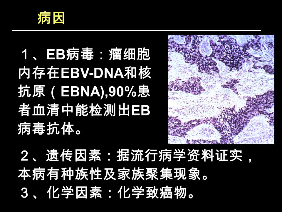 病因 ２、遗传因素：据流行病学资料证实， 本病有种族性及家族聚集现象。 ３、化学因素：化学致癌物。 １、 EB 病毒：瘤细胞 内存在 EBV-DNA 和核 抗原（ EBNA),90% 患 者血清中能检测出 EB 病毒抗体。