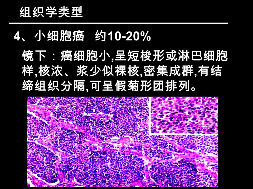 组织学类型 4 、小细胞癌 约 10-20% 镜下：癌细胞小, 呈短梭形或淋巴细胞 样, 核浓、浆少似裸核, 密集成群, 有结 缔组织分隔, 可呈假菊形团排列。