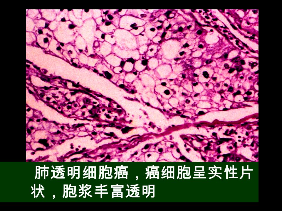 肺透明细胞癌，癌细胞呈实性片 状，胞浆丰富透明