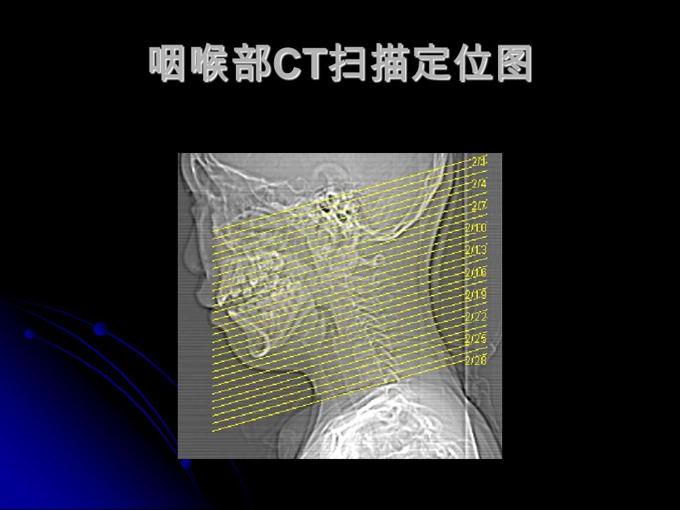 咽喉部 CT 扫描定位图