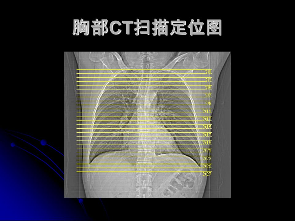 胸部 CT 扫描定位图