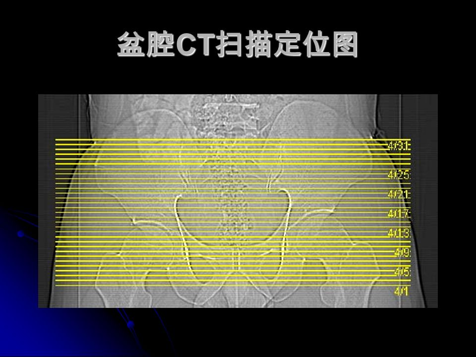 盆腔 CT 扫描定位图