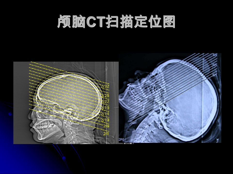 颅脑 CT 扫描定位图