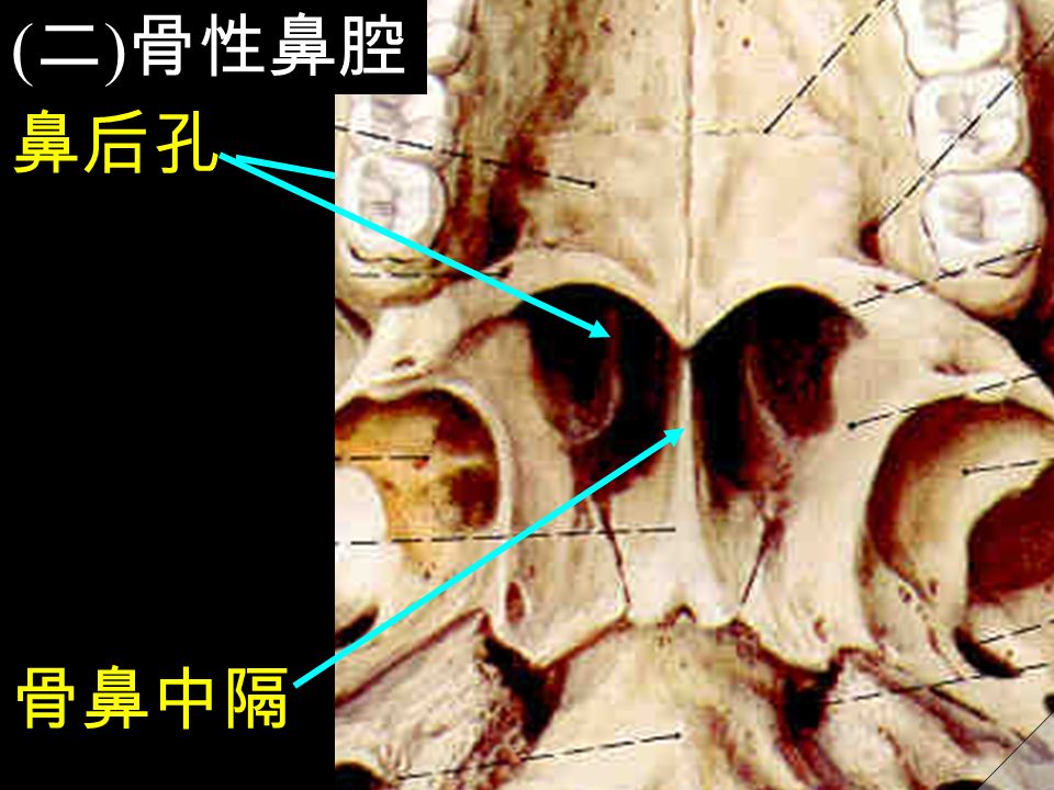 ( 二 ) 骨性鼻腔 鼻后孔 骨鼻中隔