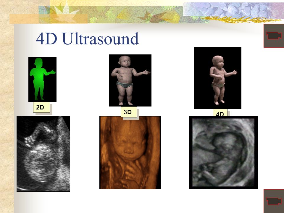 4D Ultrasound 2D 3D 4D