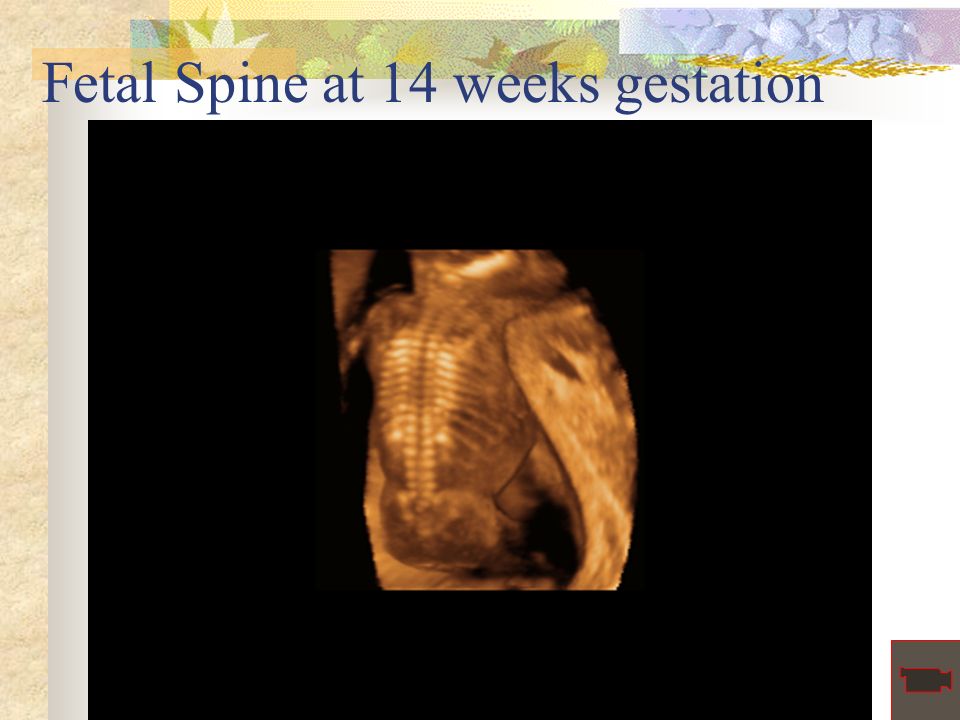Fetal Spine at 14 weeks gestation