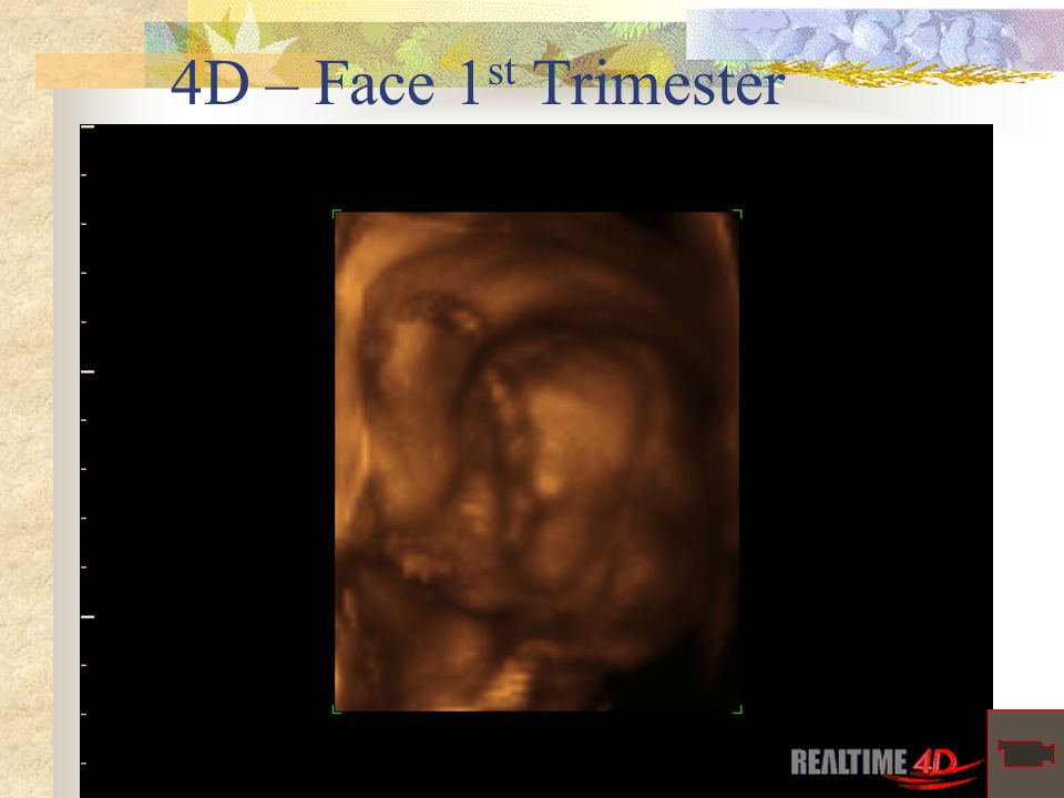 4D – Face 1 st Trimester