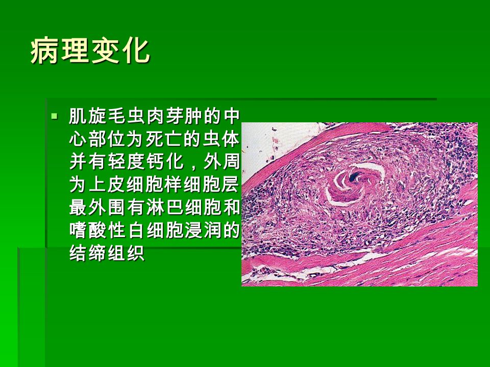 病理变化  肌旋毛虫肉芽肿的中 心部位为死亡的虫体， 并有轻度钙化，外周 为上皮细胞样细胞层， 最外围有淋巴细胞和 嗜酸性白细胞浸润的 结缔组织