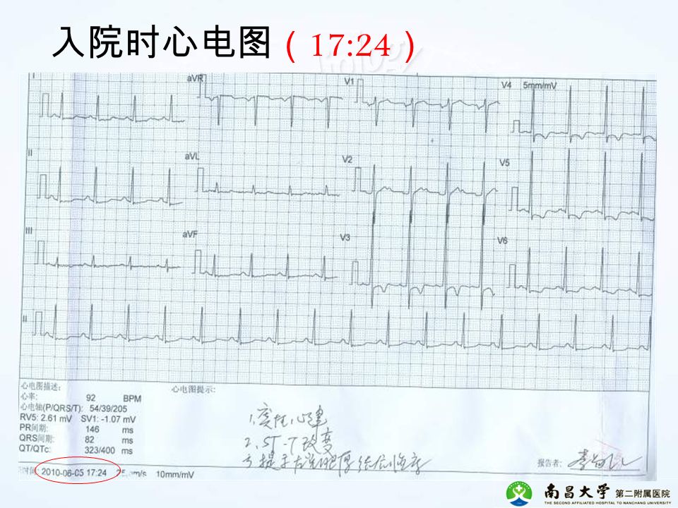 入院时心电图 （ 17:24 ）