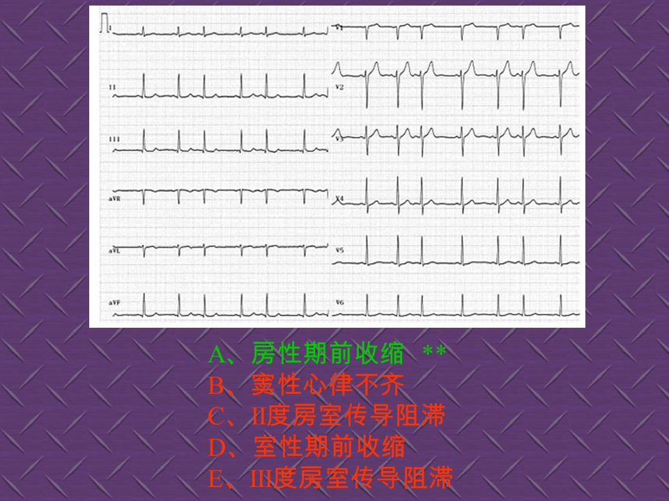 A 、大致正常心电图 ** B 、心肌缺血 C 、预激综合征 D 、房性心动过速 E 、室性心动过速
