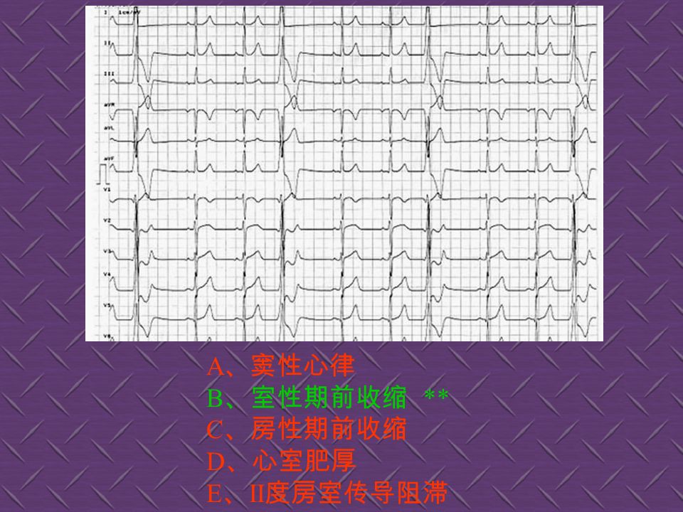 A 、正常心电图 B 、房性期前收缩 ** C 、室性期前收缩 D 、窦性心律不齐 E 、预激综合征