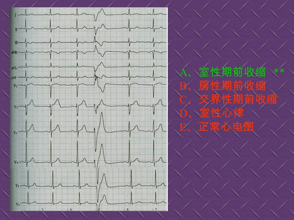 A 、窦性心律 B 、室性期前收缩 ** C 、房性期前收缩 D 、心室肥厚 E 、 II 度房室传导阻滞