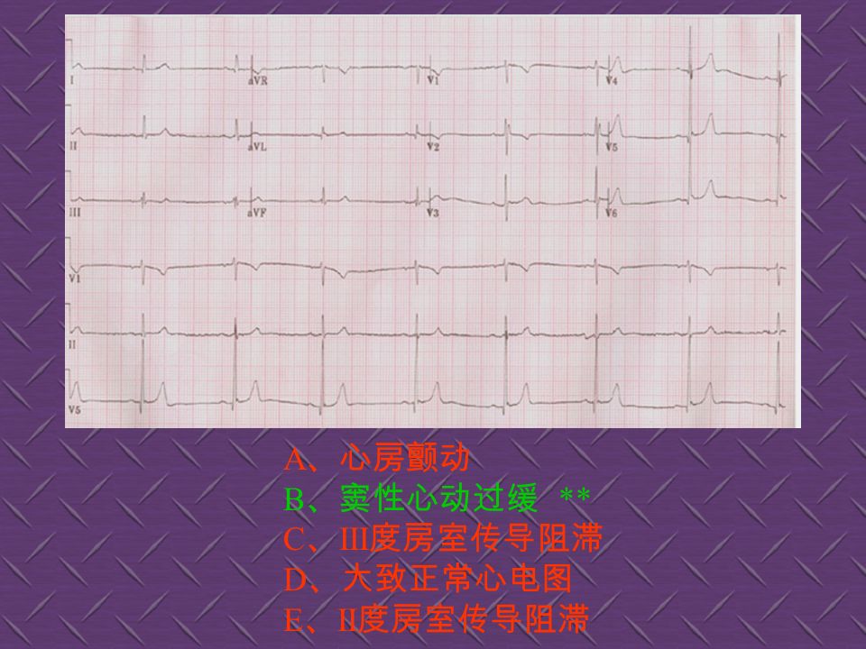 A 、室性期前收缩 ** B 、房性期前收缩 C 、交界性期前收缩 D 、室性心律 E 、正常心电图