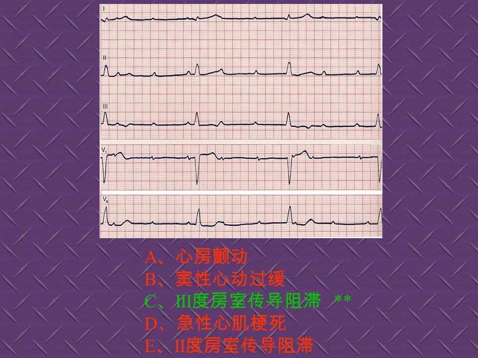 A 、正常心电图 B 、窦性心动过速 ** C 、阵发性室上性心动过速 D 、心房扑动 E 、心房颤动