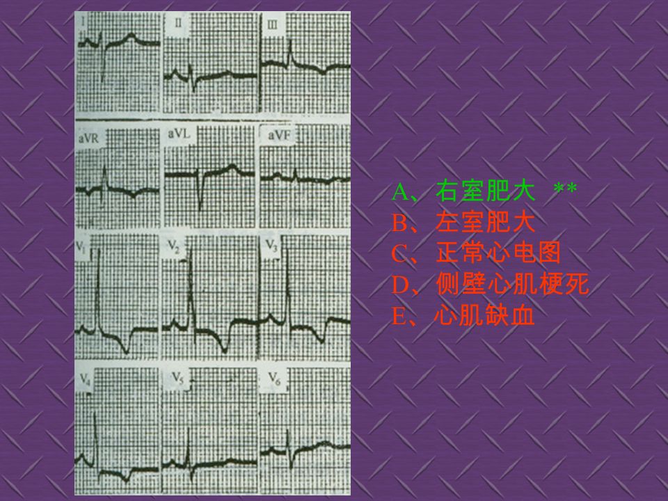A 、心房颤动 B 、窦性心动过缓 C 、 III 度房室传导阻滞 ** D 、急性心肌梗死 E 、 II 度房室传导阻滞